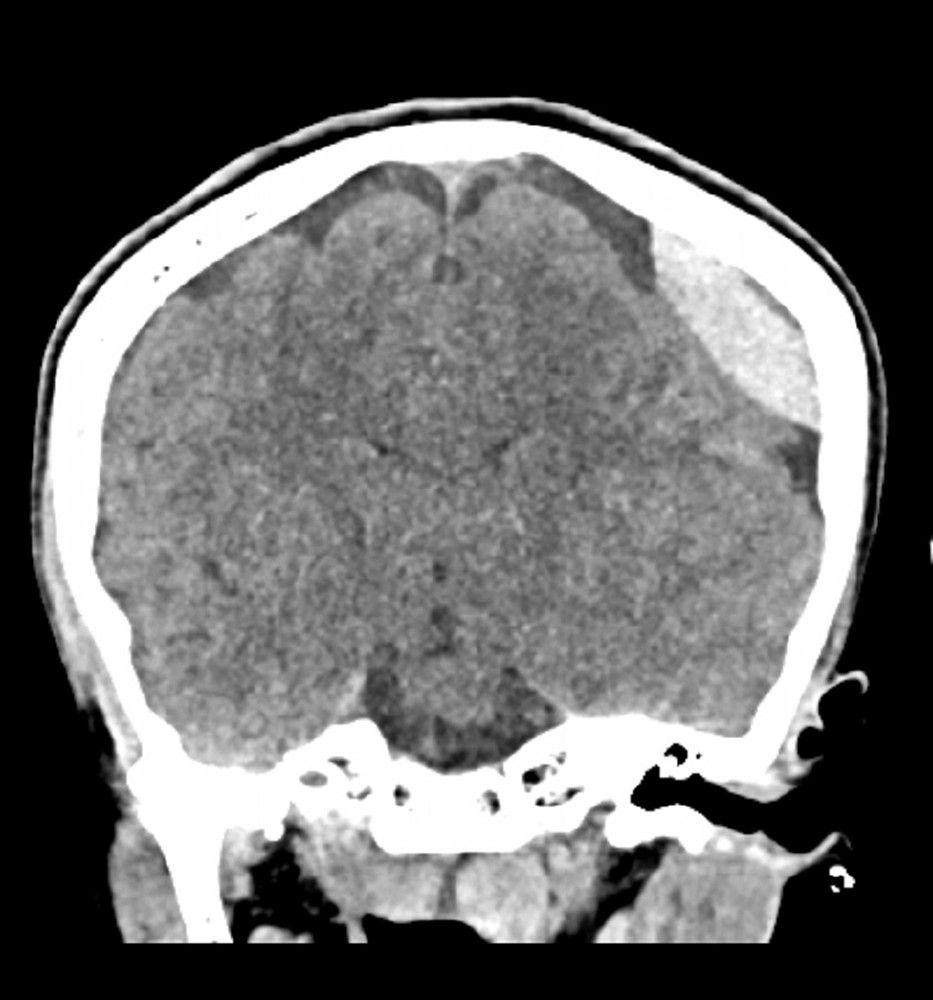 Epidural Hemorrhage (Coronal CT)