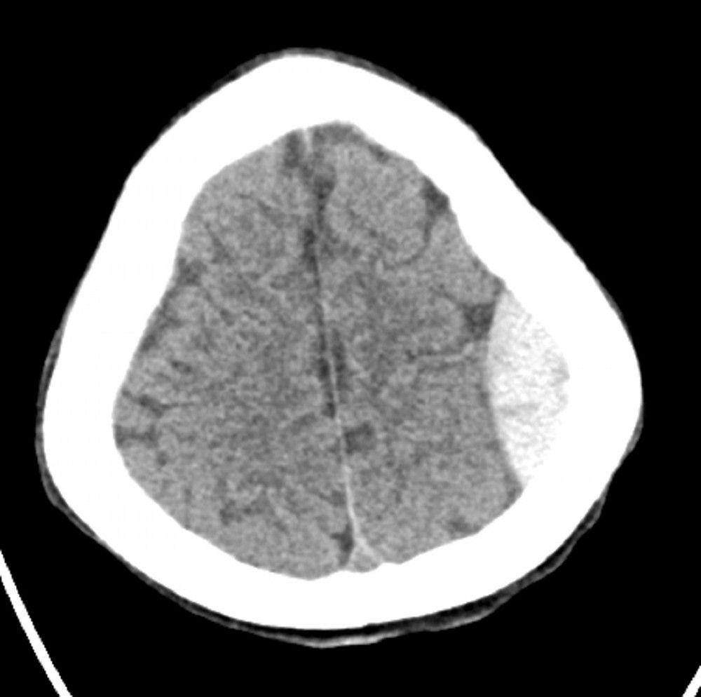 Epidural Hemorrhage (Axial CT)