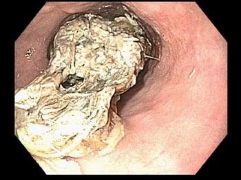 Occlusione esofagea da cibo (endoscopia)