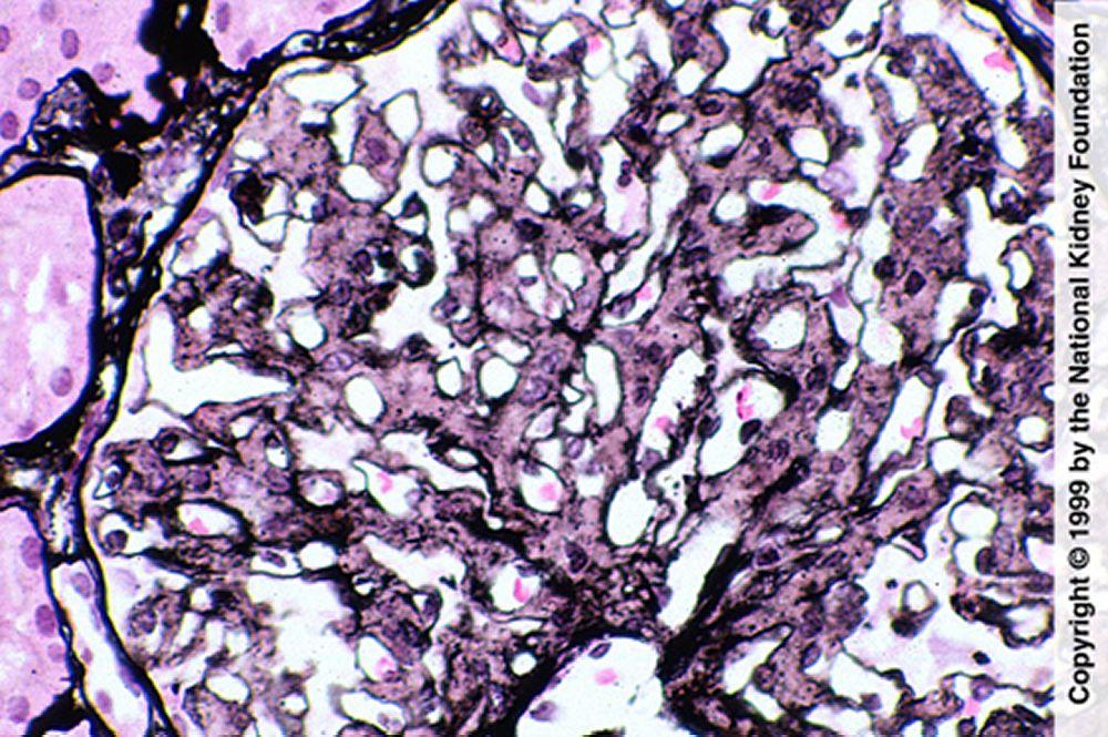 Glomerulopatia fibrilar (proliferação mesangial)