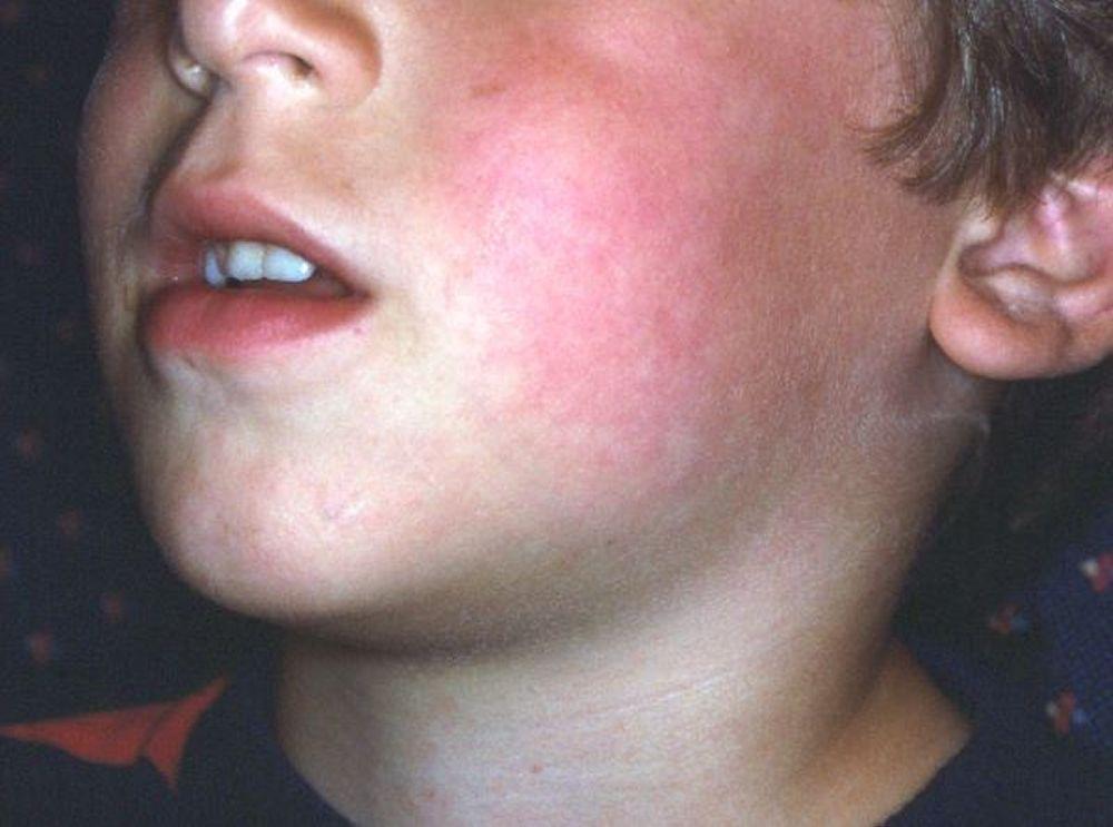 Eritema infeccioso ("face esbofeteada")