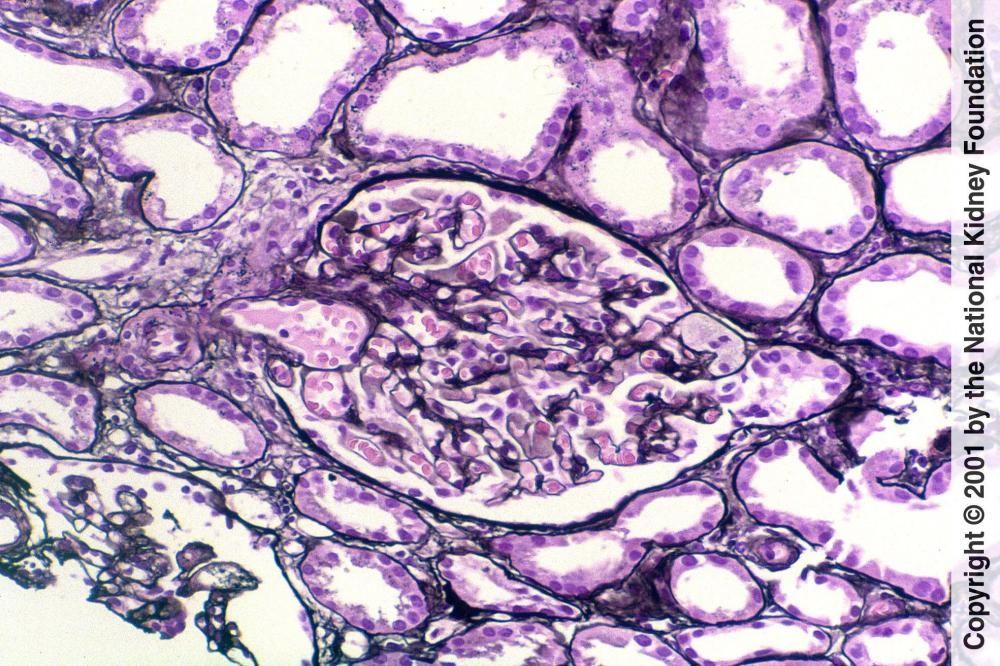 Fokal-segmentale Glomerulosklerose (tip lesion)