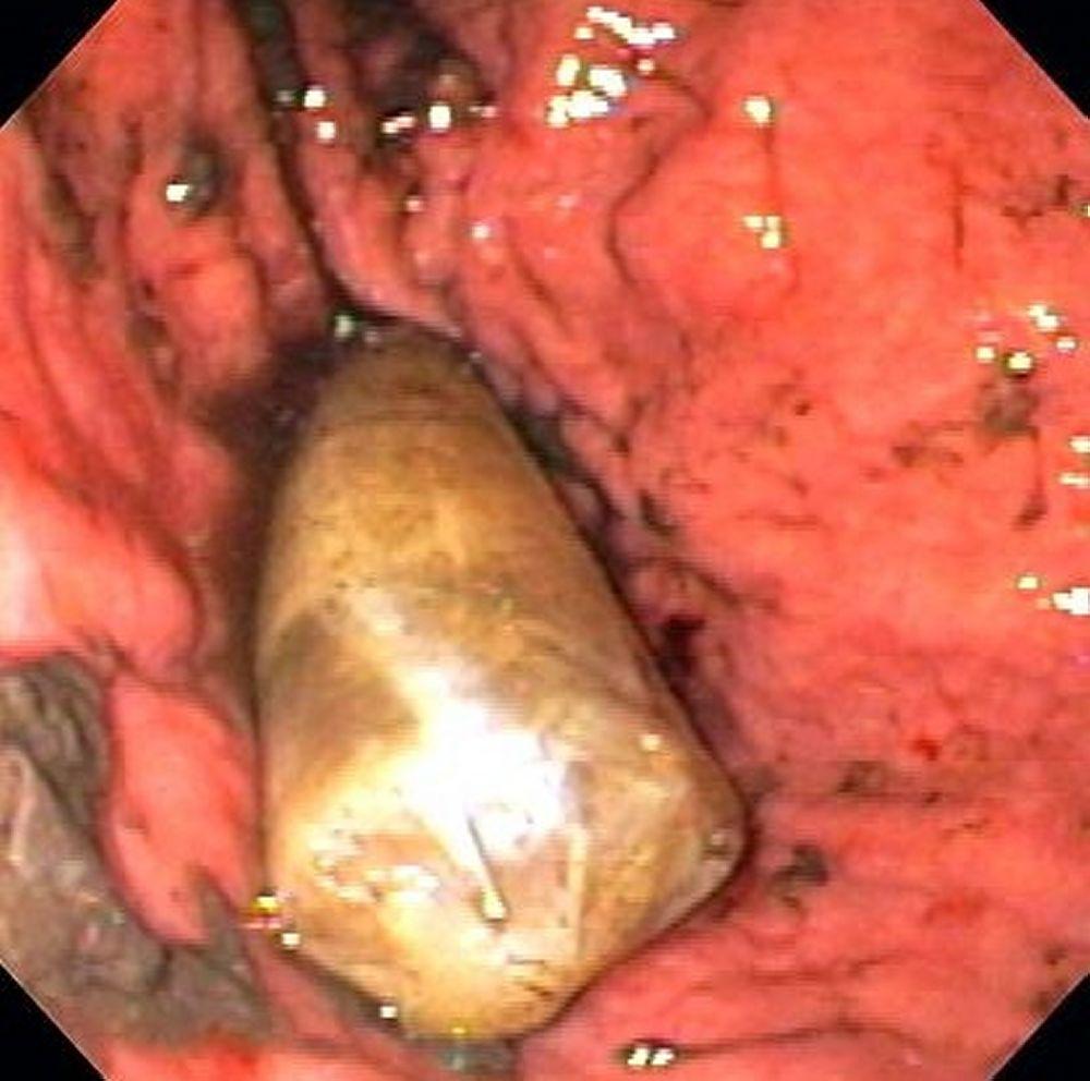 Cuerpo extraño en el estómago (endoscopia)