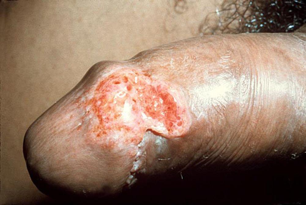 Granuloma inguinale (männlich)