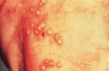 Tổn thương dạng herpes (sơ sinh)