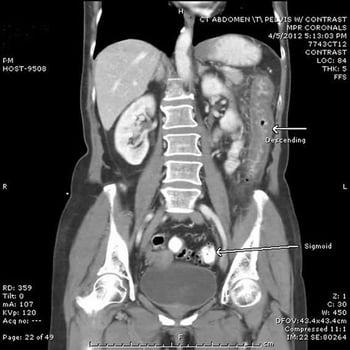 Viêm đại tràng do thiếu máu cục bộ (phim chụp CT)