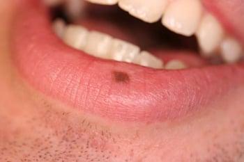 Меланотическая макула на губе