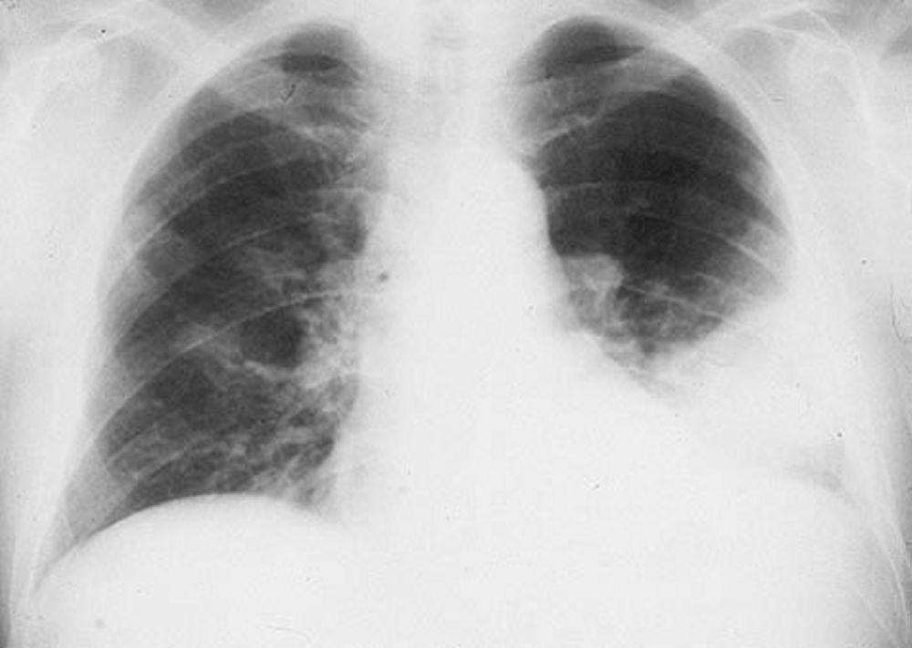Infiltrado en el lóbulo pulmonar inferior izquierdo