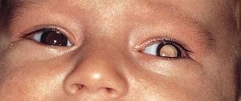 Лейкокория у младенца с ретинобластомой