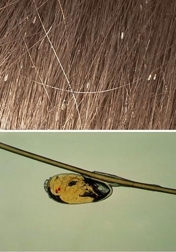 Pediculosis del cuero cabelludo (liendres)