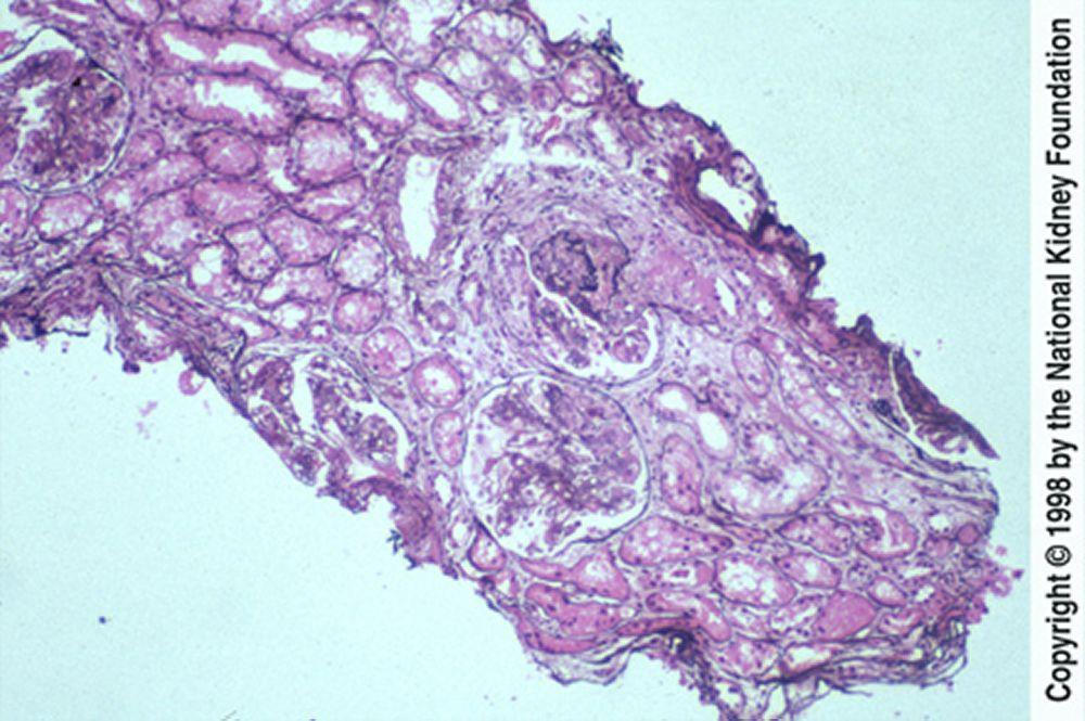 Nefritis lúpica, difusa (clase IV)