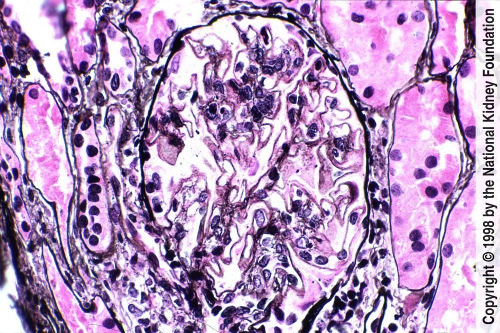 Nefrite lupica-membranosa (classe V)