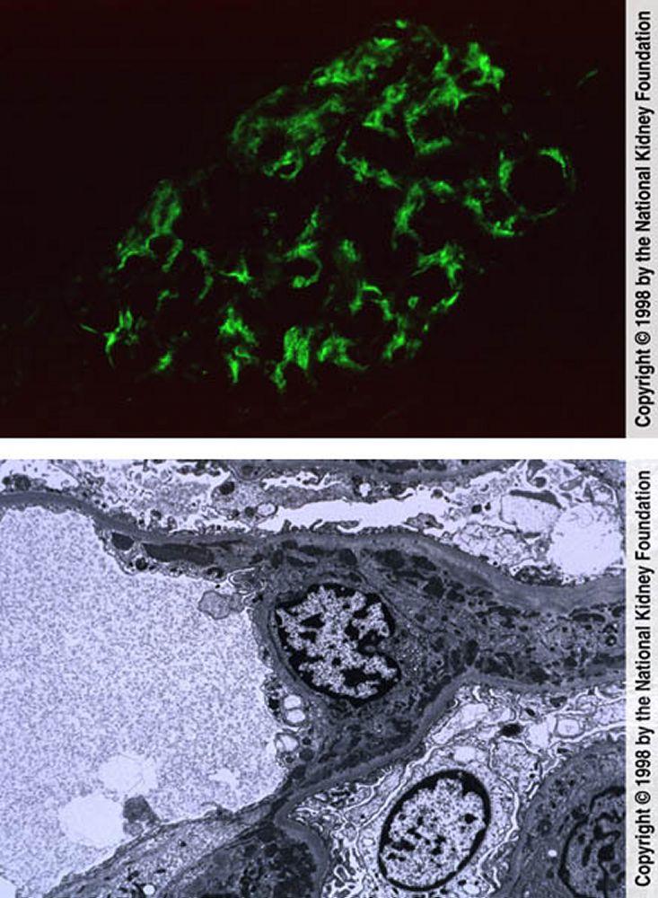 Nefrite lúpica — proliferativa mesangial (classe II)
