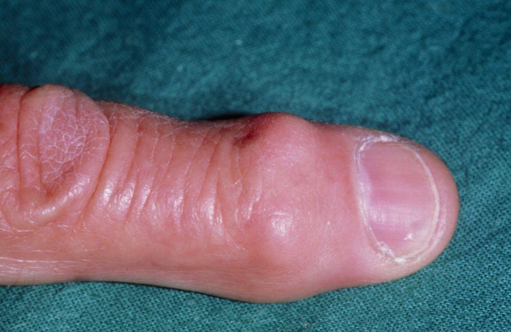 Nódulos de Heberden (artrosis)