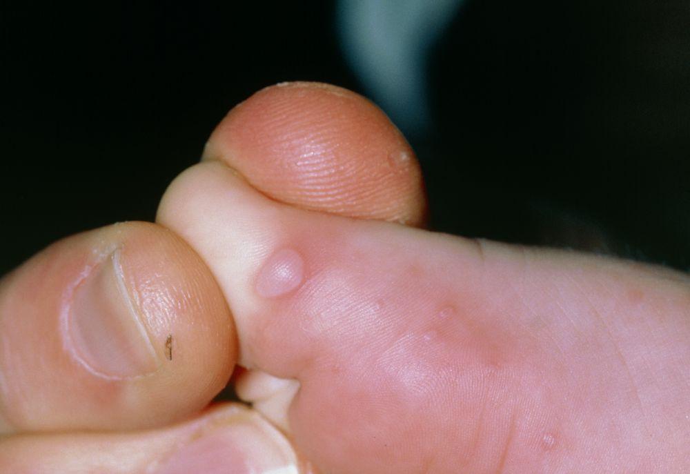 Exantema pelo vírus coxsackie A (lesões no pé)