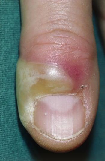Paroniquia aguda en el dedo de la mano
