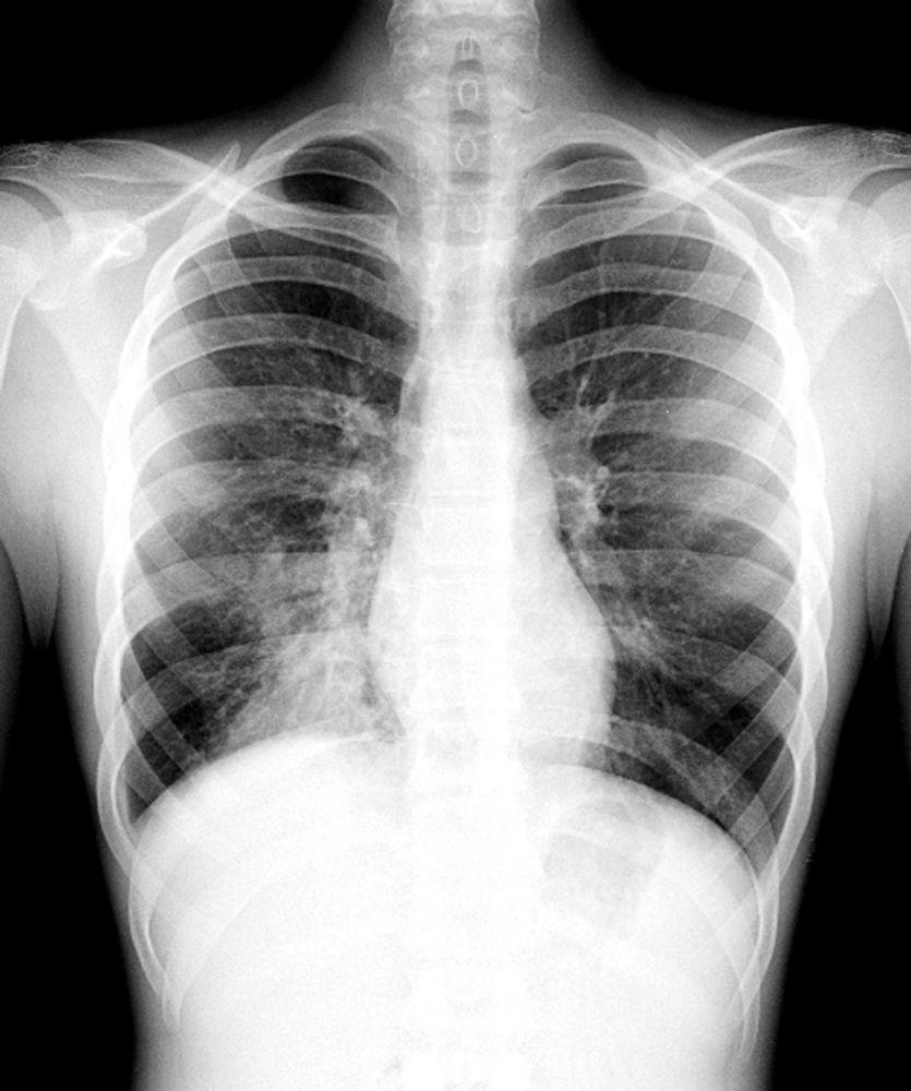 Viêm phổi thùy dưới bên phải