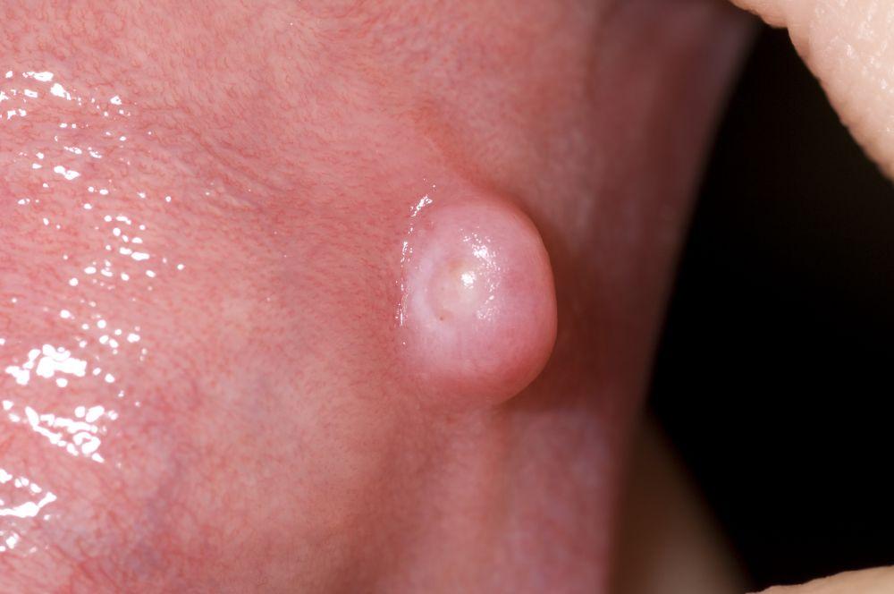 Proliferación oral benigna (fibroma irritativo)