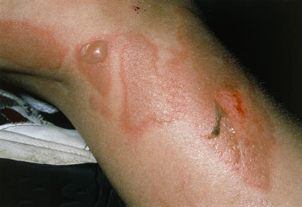Síndrome estafilocócica da pele escaldada (perna)