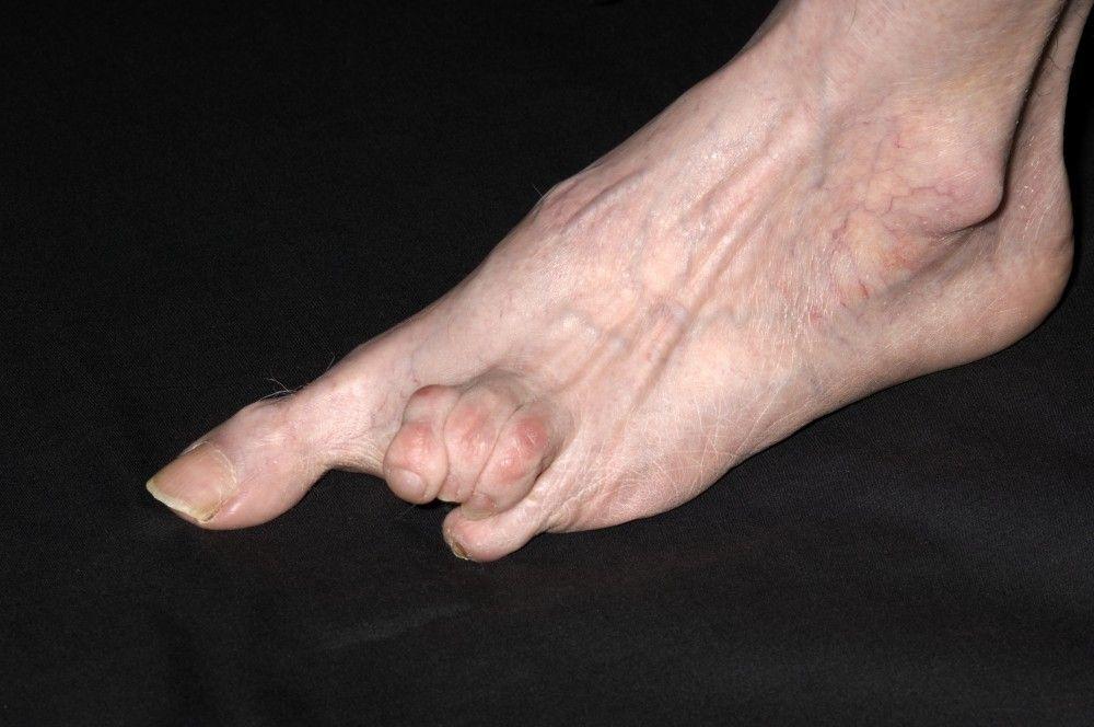 Systemic Sclerosis of the Foot