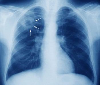 Туберкулез (рентгенограмма органов грудной клетки)