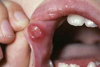 Úlcera aftosa menor (lábio)