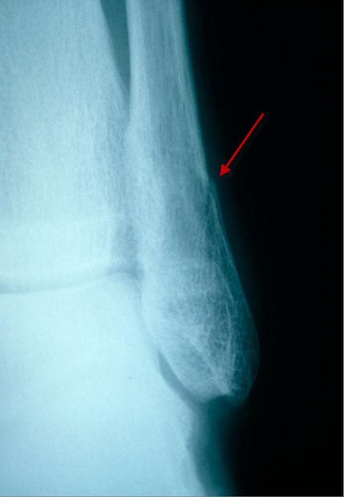 Fractura peroneal distal sutil (vista lateral)