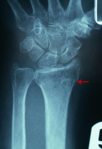 Cкрытые переломы дистального отдела лучевой кости