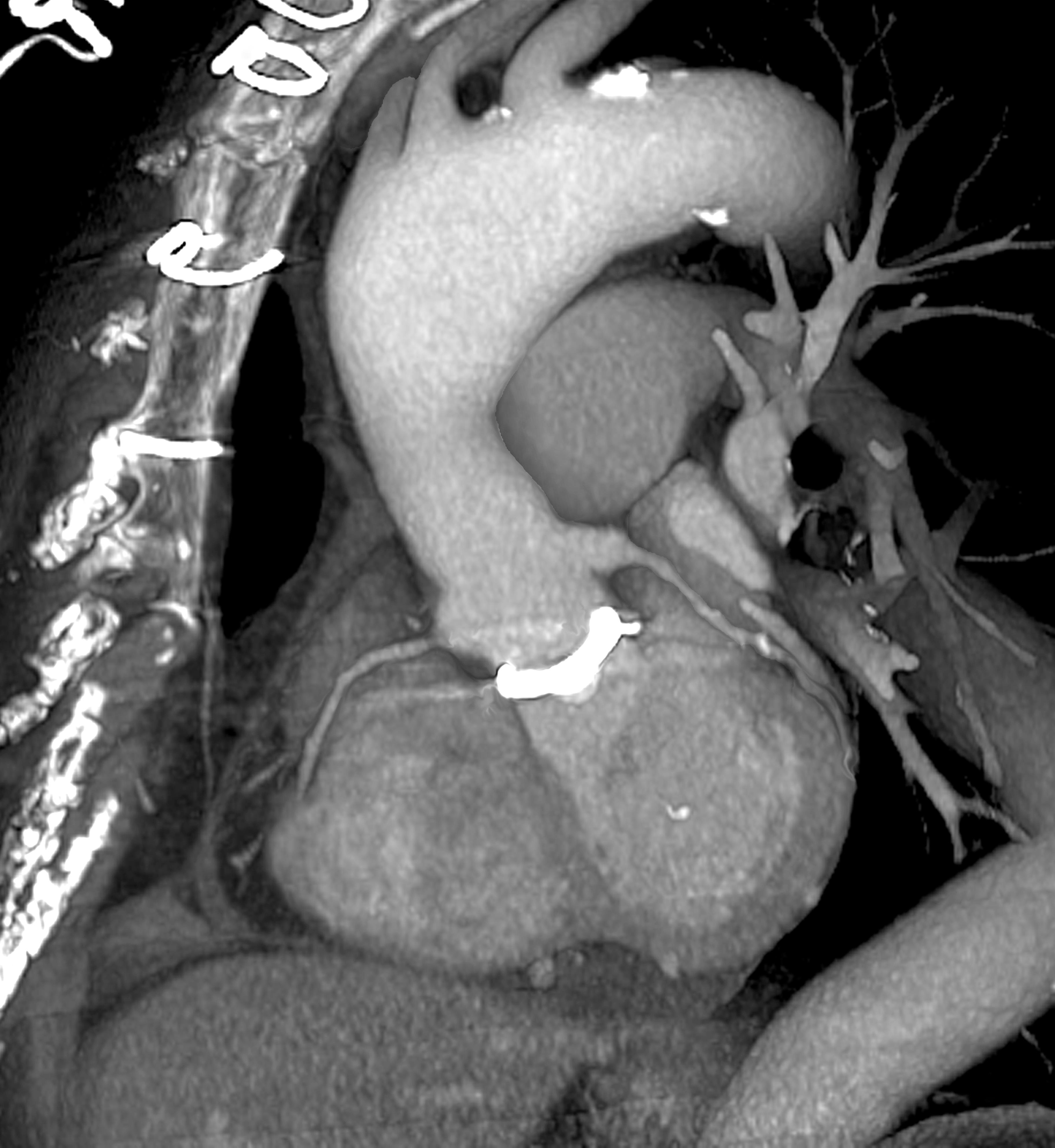 心臓CT（人工心臓弁の3次元画像）