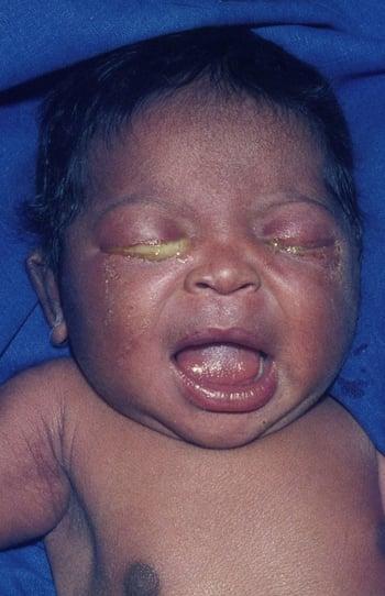 Офтальмия новорожденных