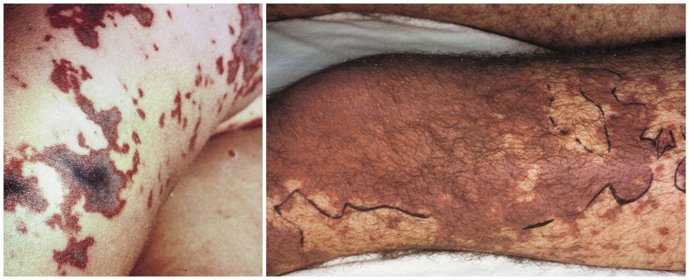 Вторичный некроз кожи при менингококкемии