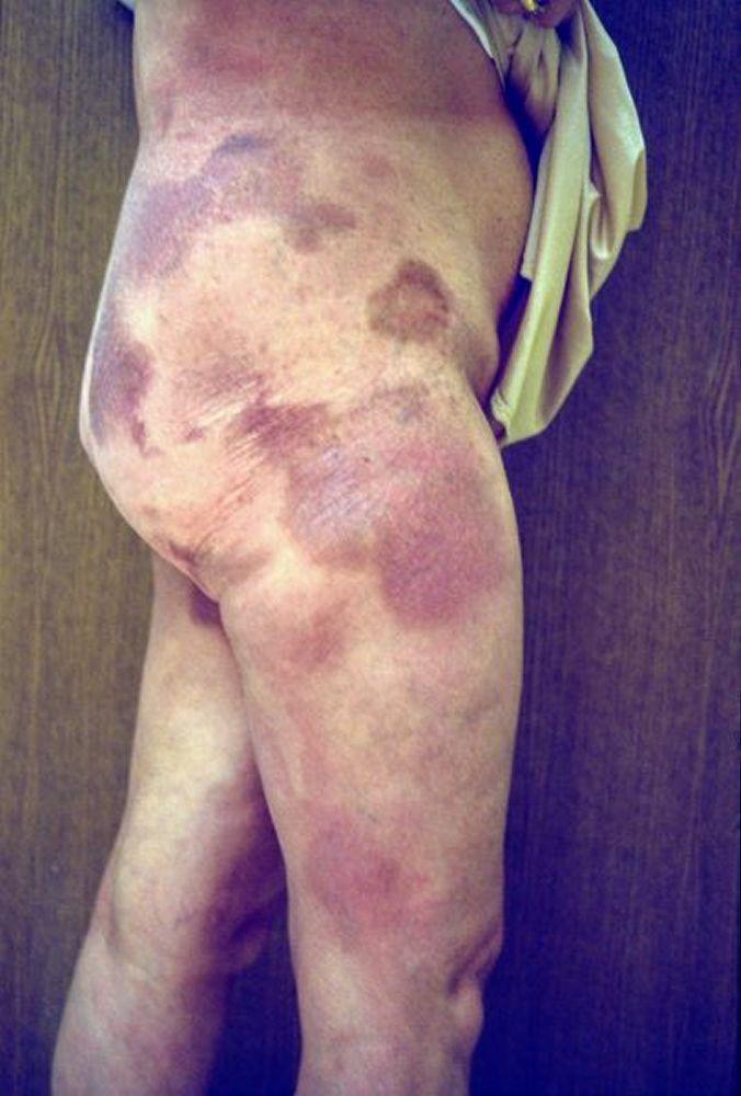 Bệnh nấm Mycosis Fungoides (thân mình và chân)