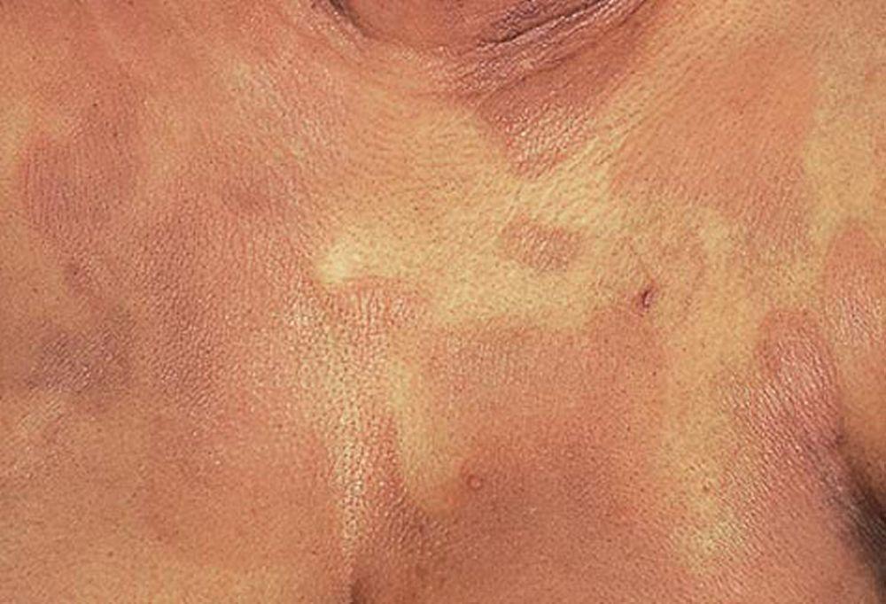 Bệnh nấm Mycosis Fungoides (ngực)