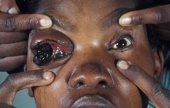 Melanoma dell'occhio