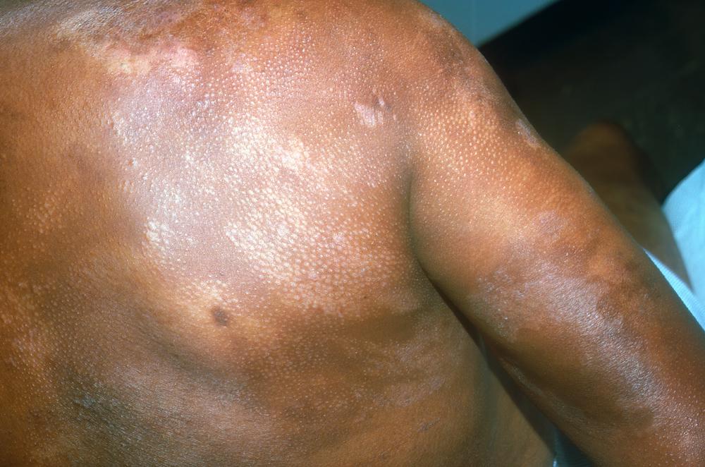 Mycosis Fungoides