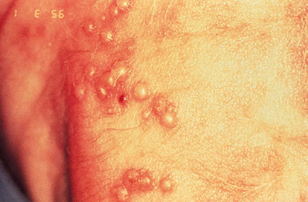 Nhiễm vi rút herpes simplex ở trẻ sơ sinh