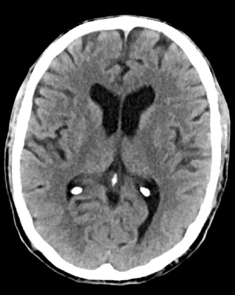 Normal Head CT Scan (Adult, Age 74) – Slide 5