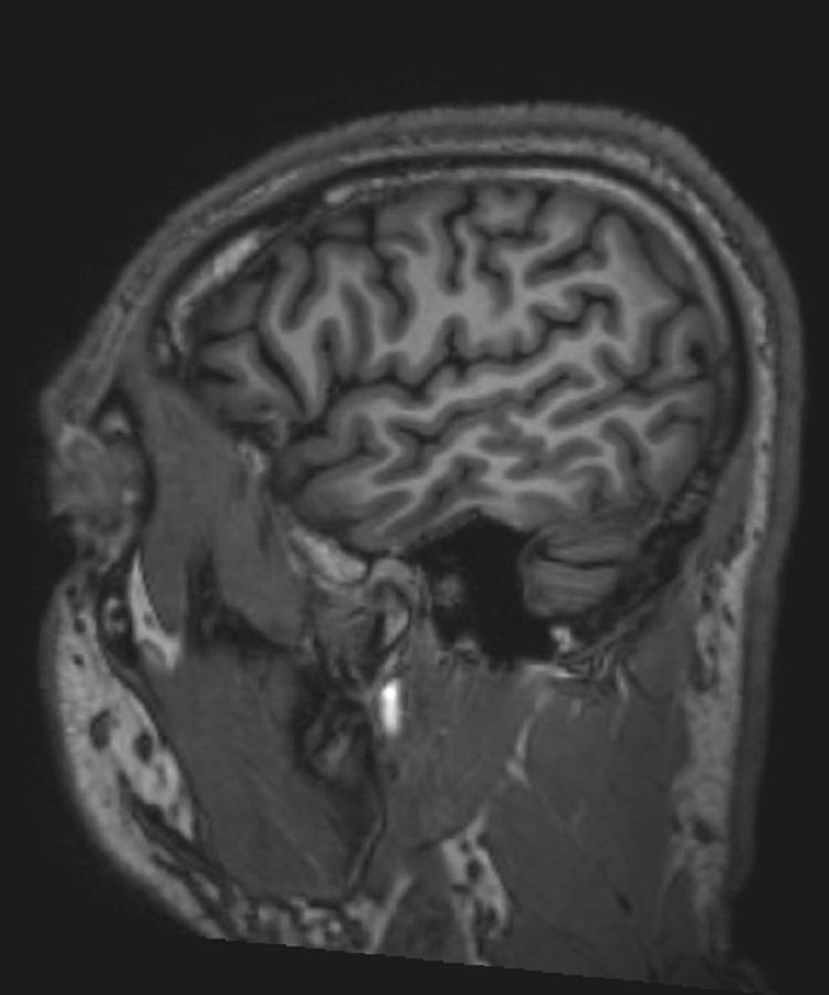 RM do cérebro normal (sagital) – Diapositivo 1
