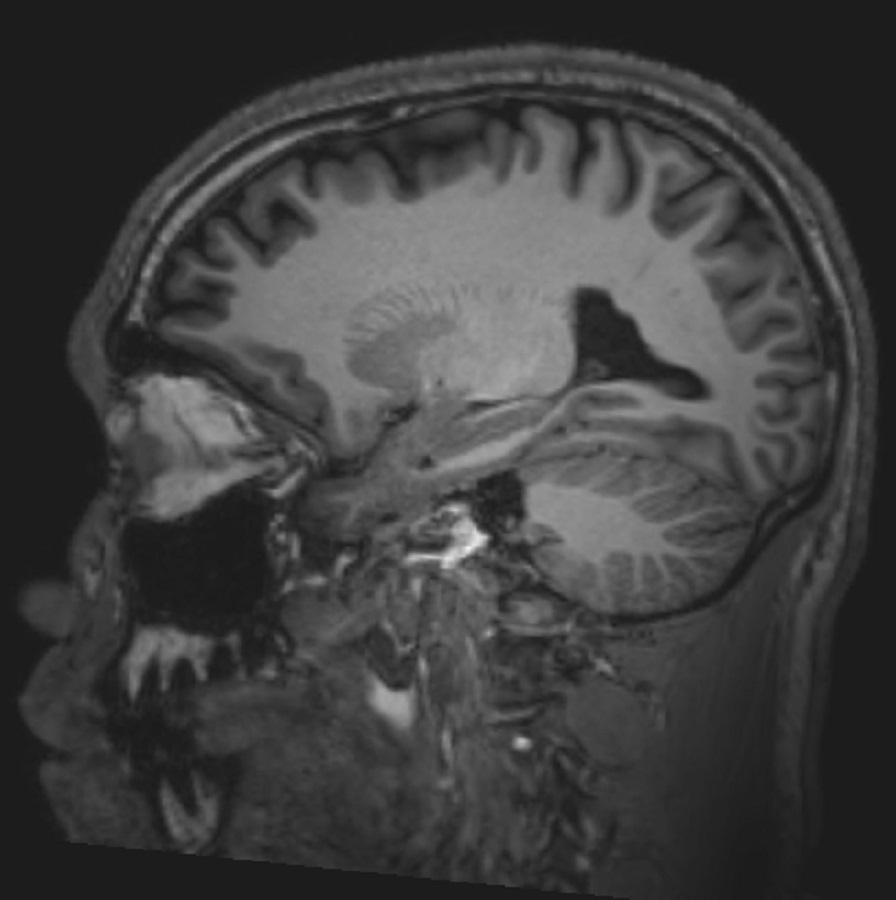 正常な脳MRI画像（矢状断像）―スライド2