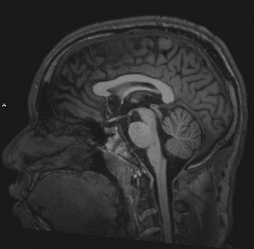 Normales MRT des Gehirns (sagittal) – Folie 4)