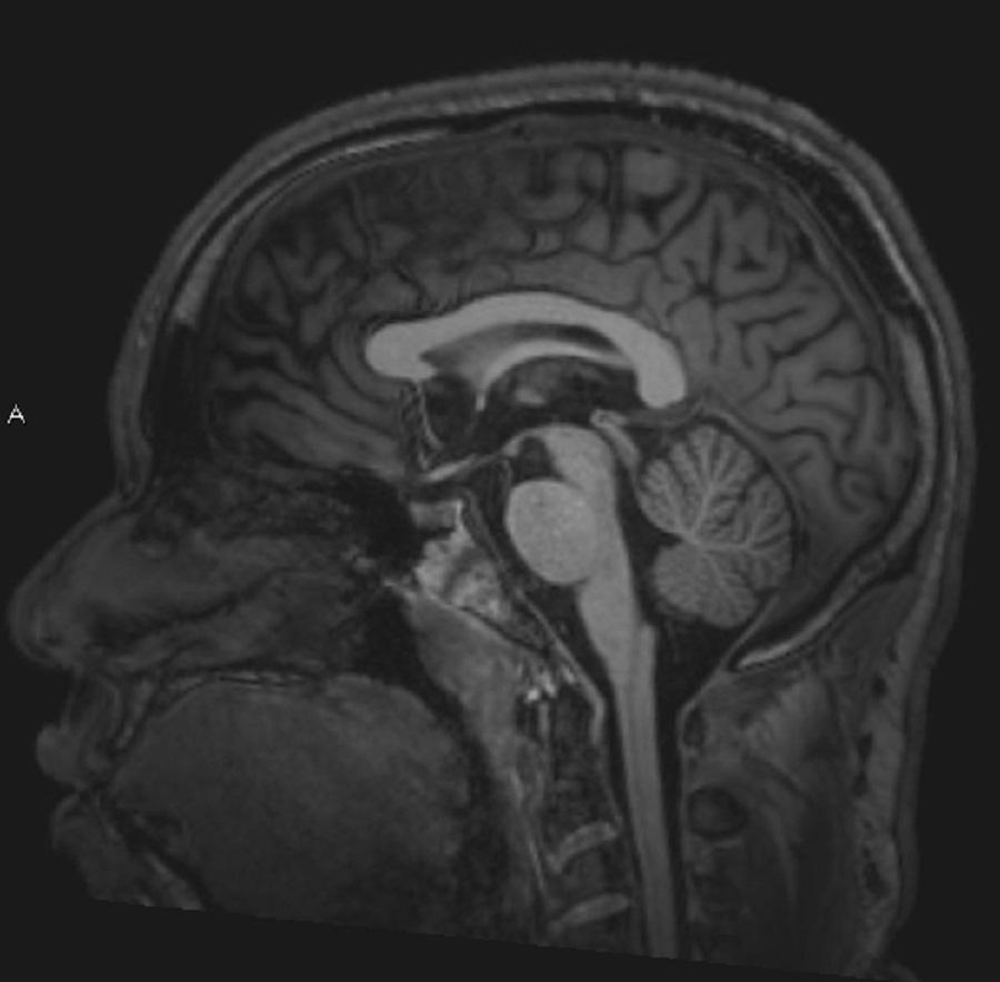 RM cerebrale normale (sagittale), slide 4