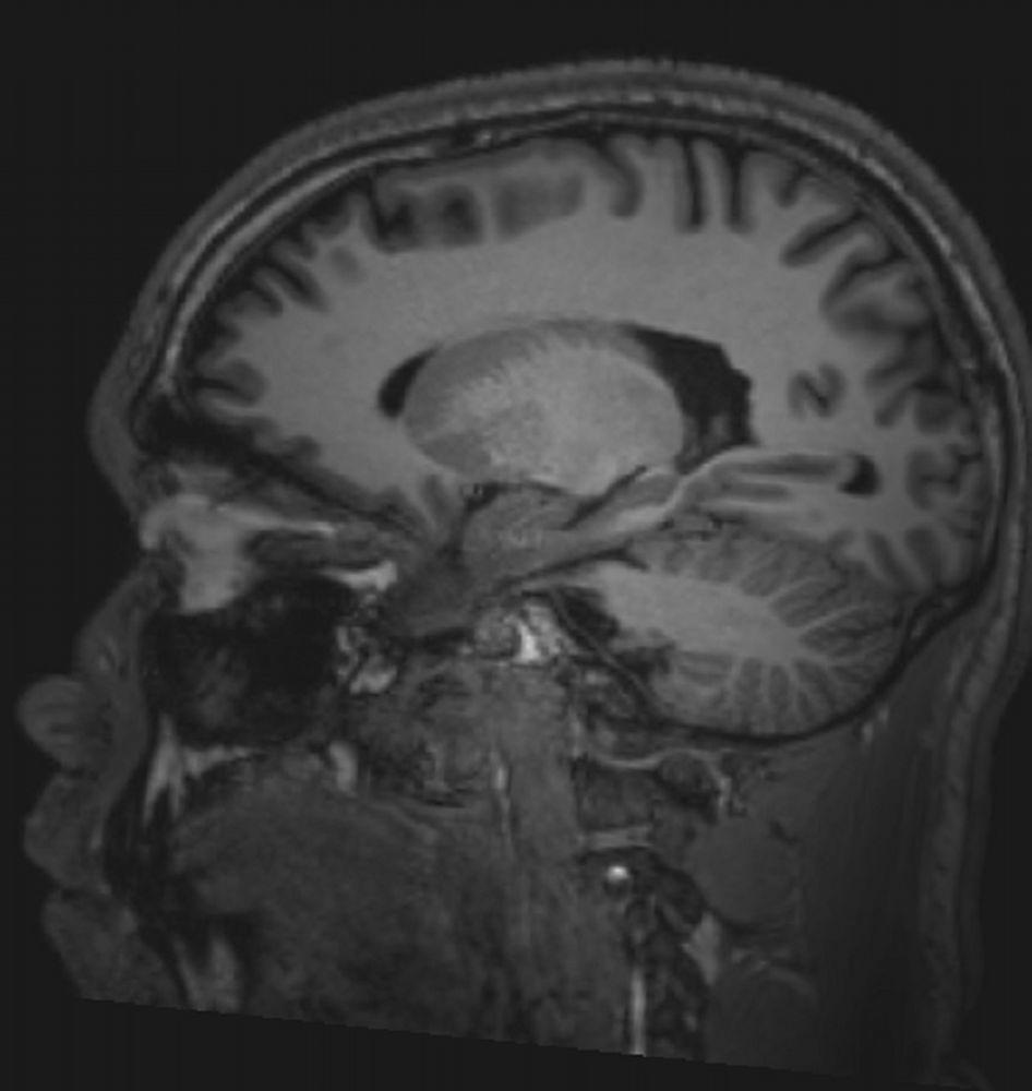 Normales MRT des Gehirns (sagittal) – Folie 5)