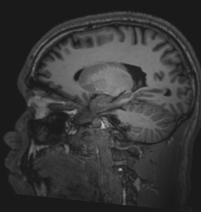 RM do cérebro normal (sagital) – Diapositivo 5