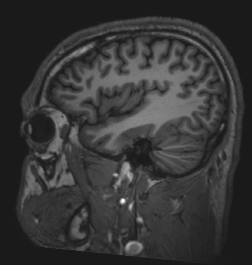 正常な脳MRI画像（矢状断像）―スライド6