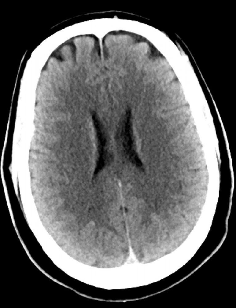 Chụp CT đầu bình thường (người lớn, 30 tuổi) – Lát cắt 3