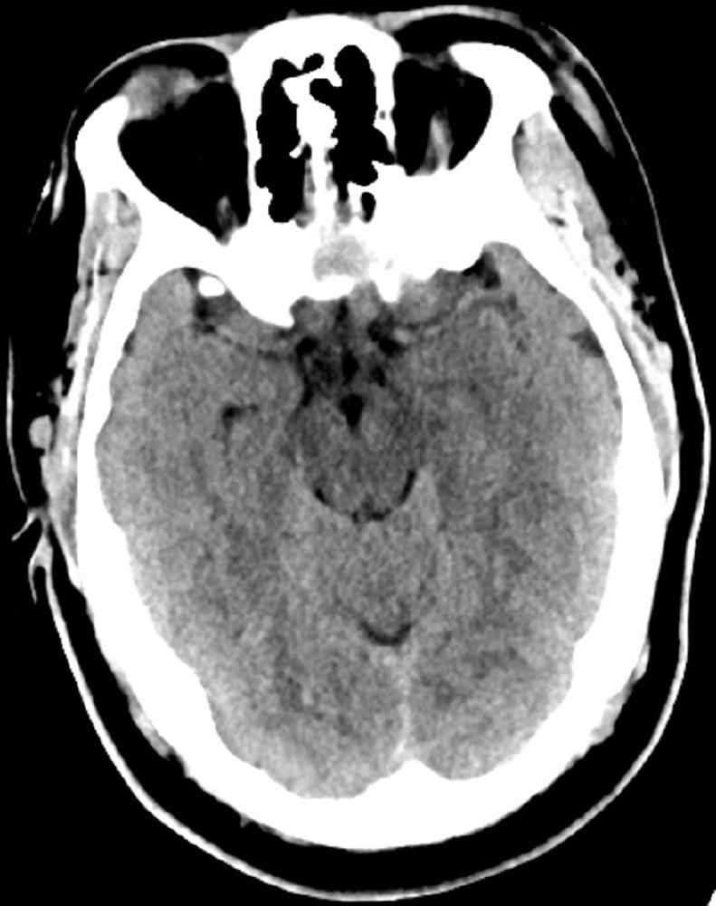 Chụp CT đầu bình thường (người lớn, 30 tuổi) – Lát cắt 6