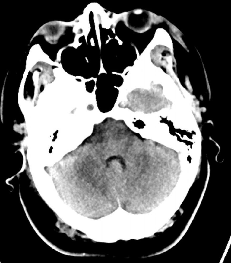Chụp CT đầu bình thường (người lớn, 30 tuổi) – Lát cắt 7