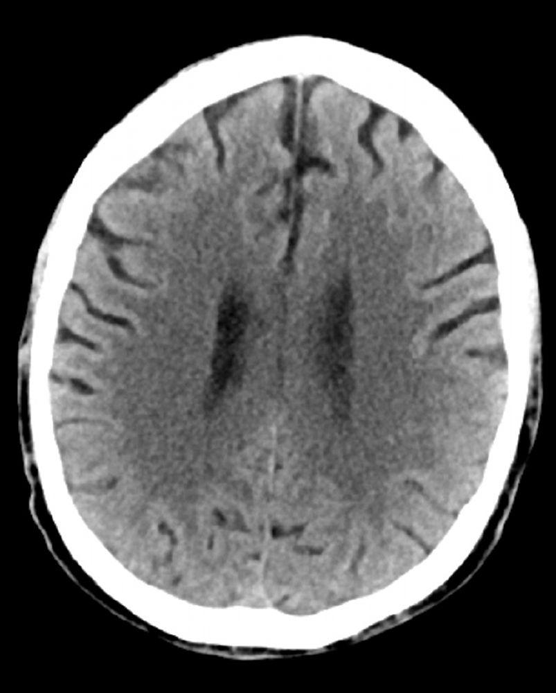Chụp CT đầu bình thường (người lớn, 74 tuổi) – Lát cắt 3