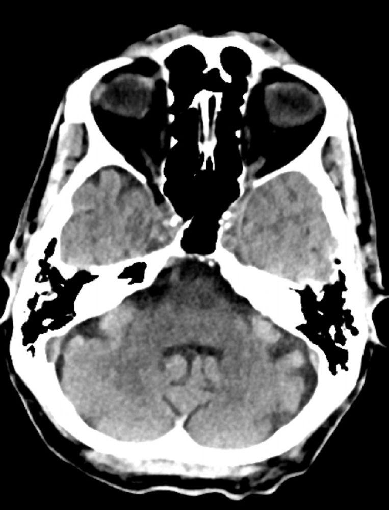 Normal Head CT Scan (Adult, Age 74) – Slide 8