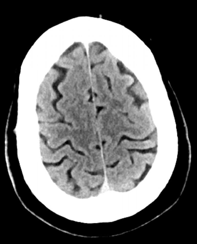 TC cerebrale normale (adulto di 30 anni), slide 1